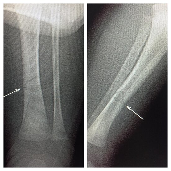 Bakıda 18 günlük körpənin qolu sındırıldı - FOTO