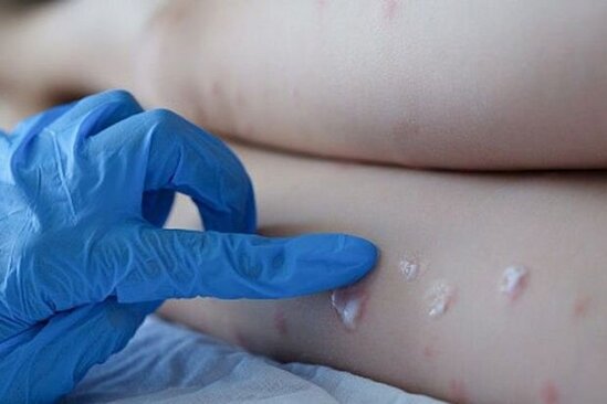 Meymunçiçəyinin sağalma müddəti və müalicədə istifadə olunan dərmanlar açıqlanıb