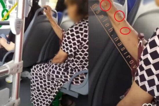 Azərbaycanda meymunçiçəyinə yoluxan şəxs var? - YENİLƏNİB + FOTO