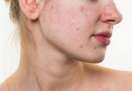 35 yaş sonrası yaranan üzdəki qırışları və məsamələr üçün effektiv vasitə