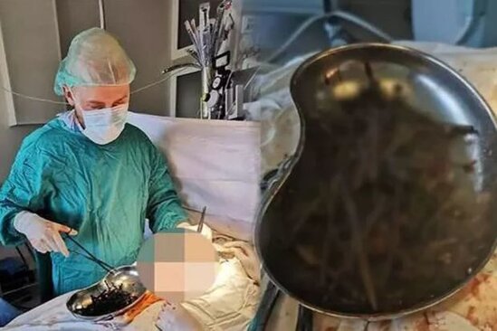 Türkiyədə gənc qızın mədəsindən 158 metal əşya çıxdı – VİDEO