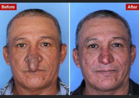 Burnu ağzına girdiyinə görə əməliyyat olundu - FOTO