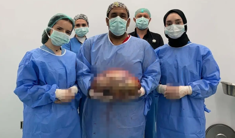 Bursada qadının qarın boşluğundan 10 kiloqramlıq kütlə çıxarıldı