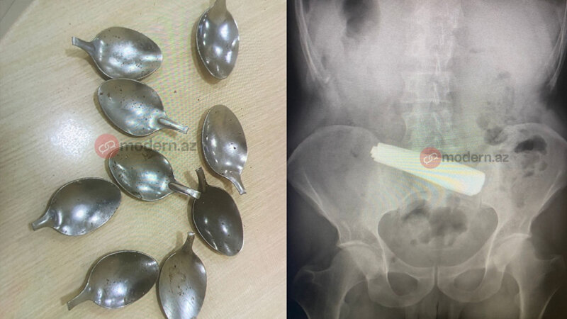 Bakıda bir nəfər 9 ədəd qaşıq uddu (FOTO)