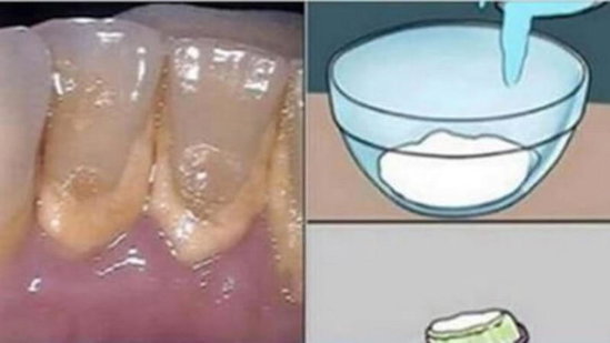 Diş daşı ölümə səbəb olurmuş - VACİB MƏLUMAT