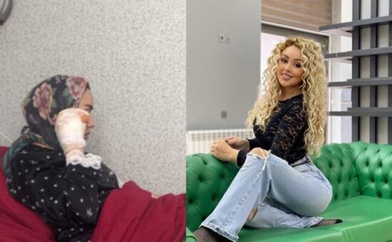 "Saçlarım artıq yoxdur" - Partlayışda yaralanan model