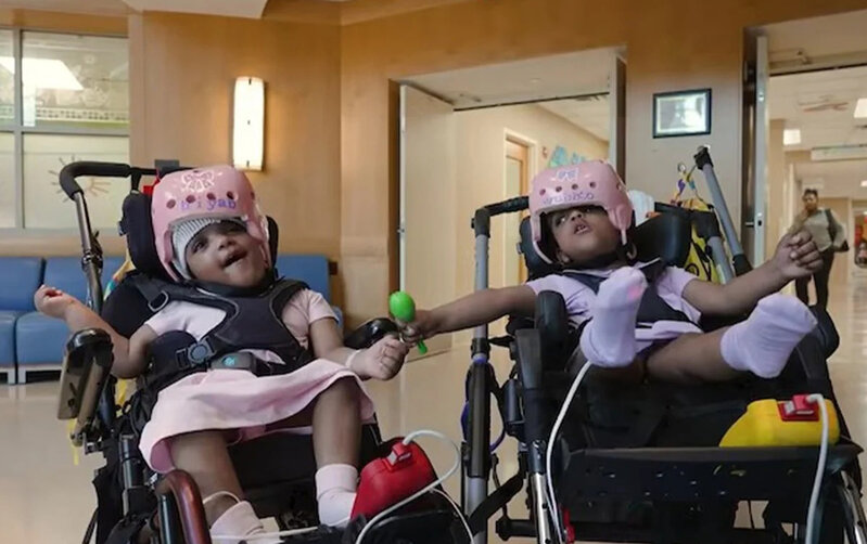 Başları bitişik doğulan siam əkizləri bir-birindən ayrıldı - Foto