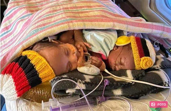 Avstraliyada siam əkizləri üzərində mürəkkəb əməliyyat: Körpələrdən biri sağ qaldı