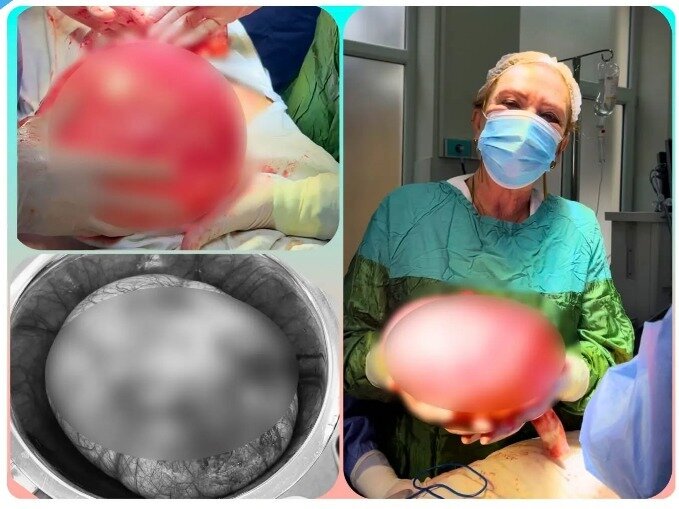 Bakıda ŞOK: gənc qızın qarnından 5 kiloluq şiş çıxdı