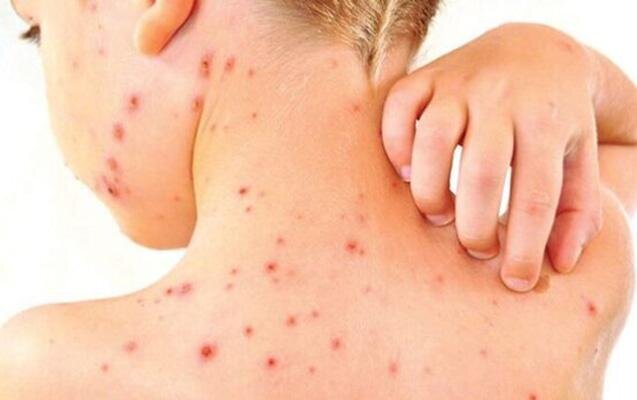 Qızılca ilə qripi necə fərqləndirək? - AÇIQLAMA