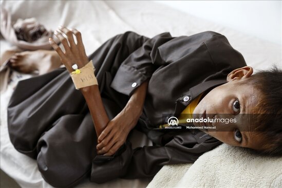 Yəməndəki uşaqların halı ürək ağrıtdı - FOTOLAR