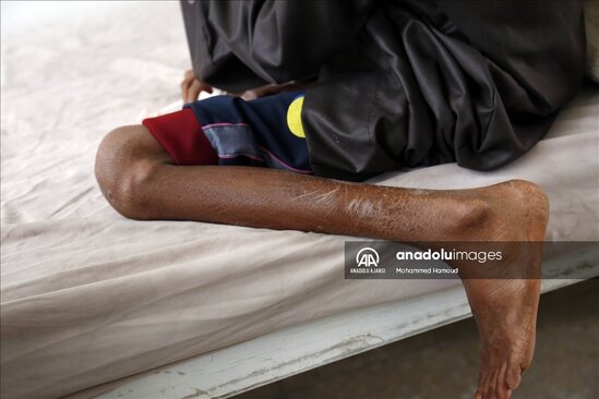 Yəməndəki uşaqların halı ürək ağrıtdı - FOTOLAR