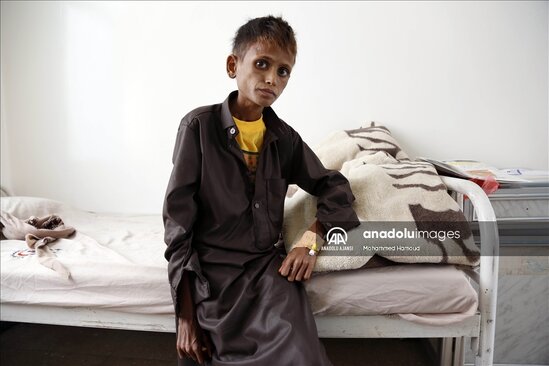Yəməndəki uşaqların halı ürək ağrıtdı - FOTOLAR