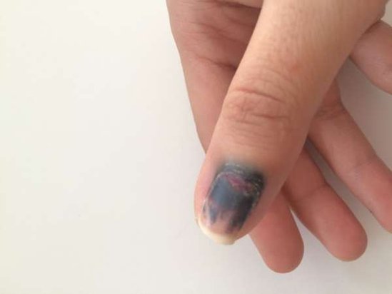 Dırnağınız göyəribsə...