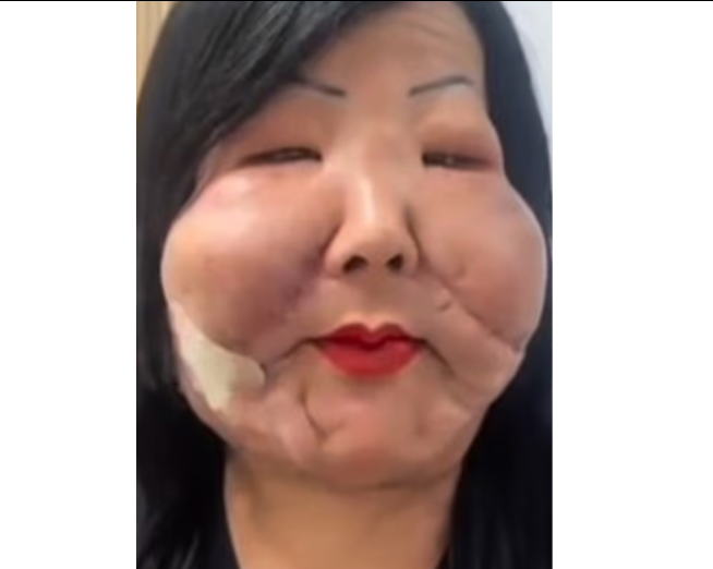 Gözəllik uğrunda üzü tanınmaz hala düşdü amma yenə ağıllanmadı