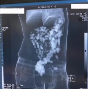 Mədələrindən 2 kilo heroin çıxdı - VİDEO