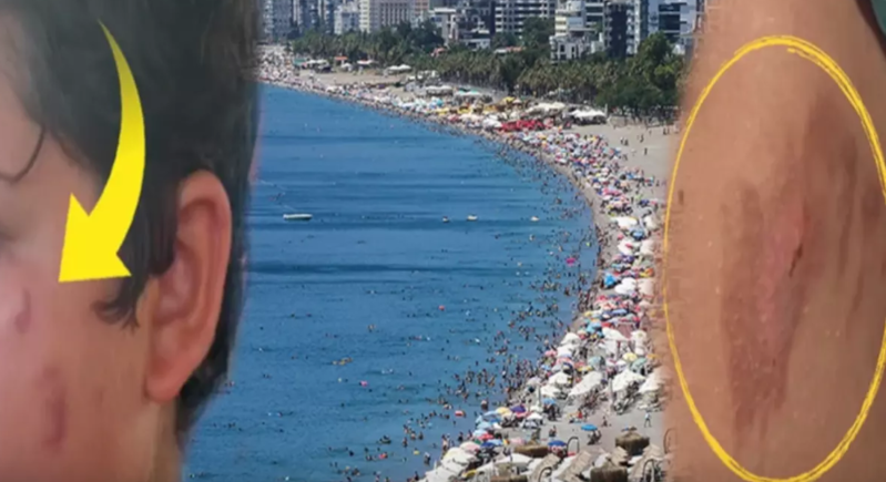 Vətəndaşlar narahatdır! Dənizə girən yanıqlarla çıxır!