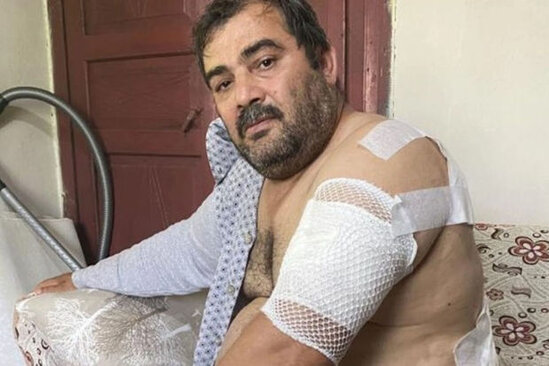 Ayının hücumuna məruz qalan kişinin bədəninə 60 tikiş qoyulub - FOTO