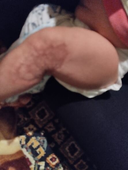 8 aylıq körpə odun sobasının üzərinə düşüb - FOTO