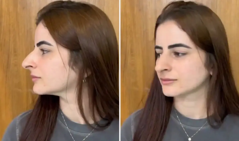 Həvəslə burun estetiki elətdirdi, nəticə skandal! - VİDEO